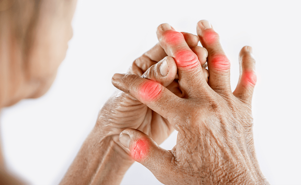 A close-up image showing inflamed joints in a person's hands, illustrating the need to learn how to manage arthritis pain naturally